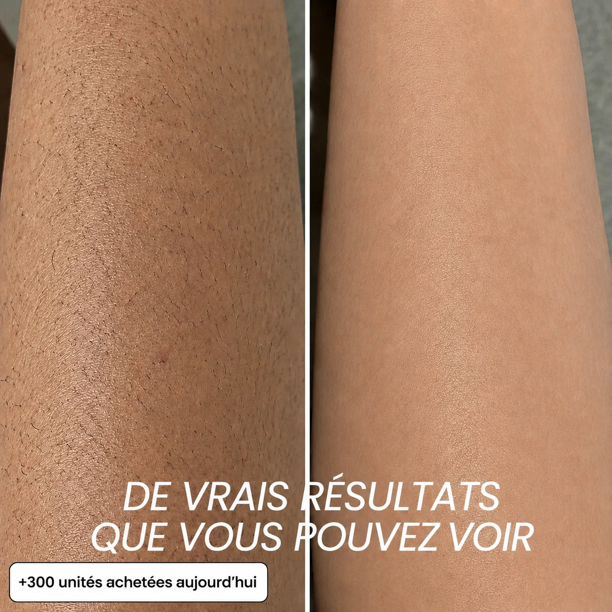 Rasez-vous 3× moins souvent — sans laser, sans rendez-vous.