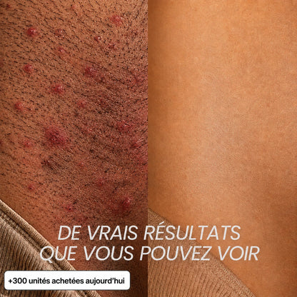 Rasez-vous 3× moins souvent — sans laser, sans rendez-vous.
